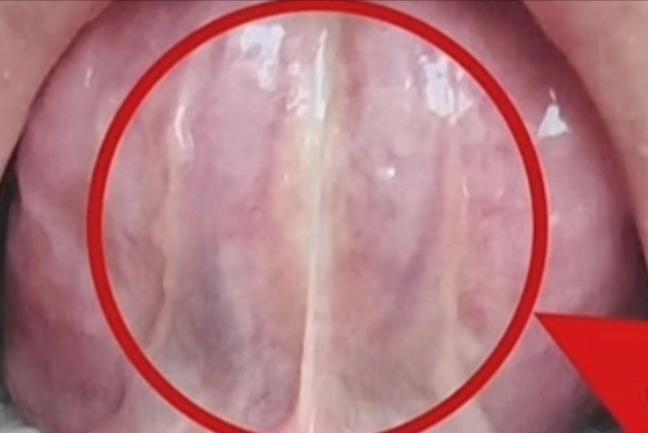 常见的6种舌底，快来对比一下！

1.正常人的舌底
健康人的舌底黏膜是均匀的淡红