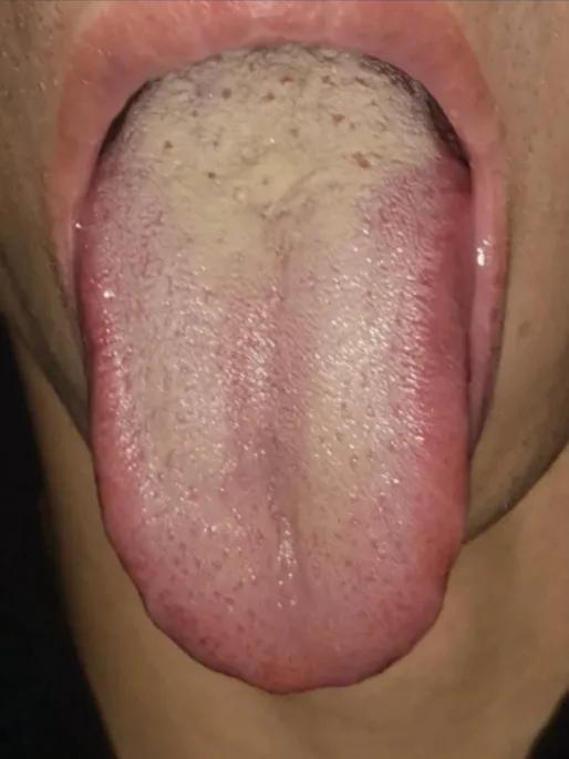 这种舌头，还在不停吃六味地黄，我看你是真的在拿身体开玩笑！
 
先来看一下舌象：