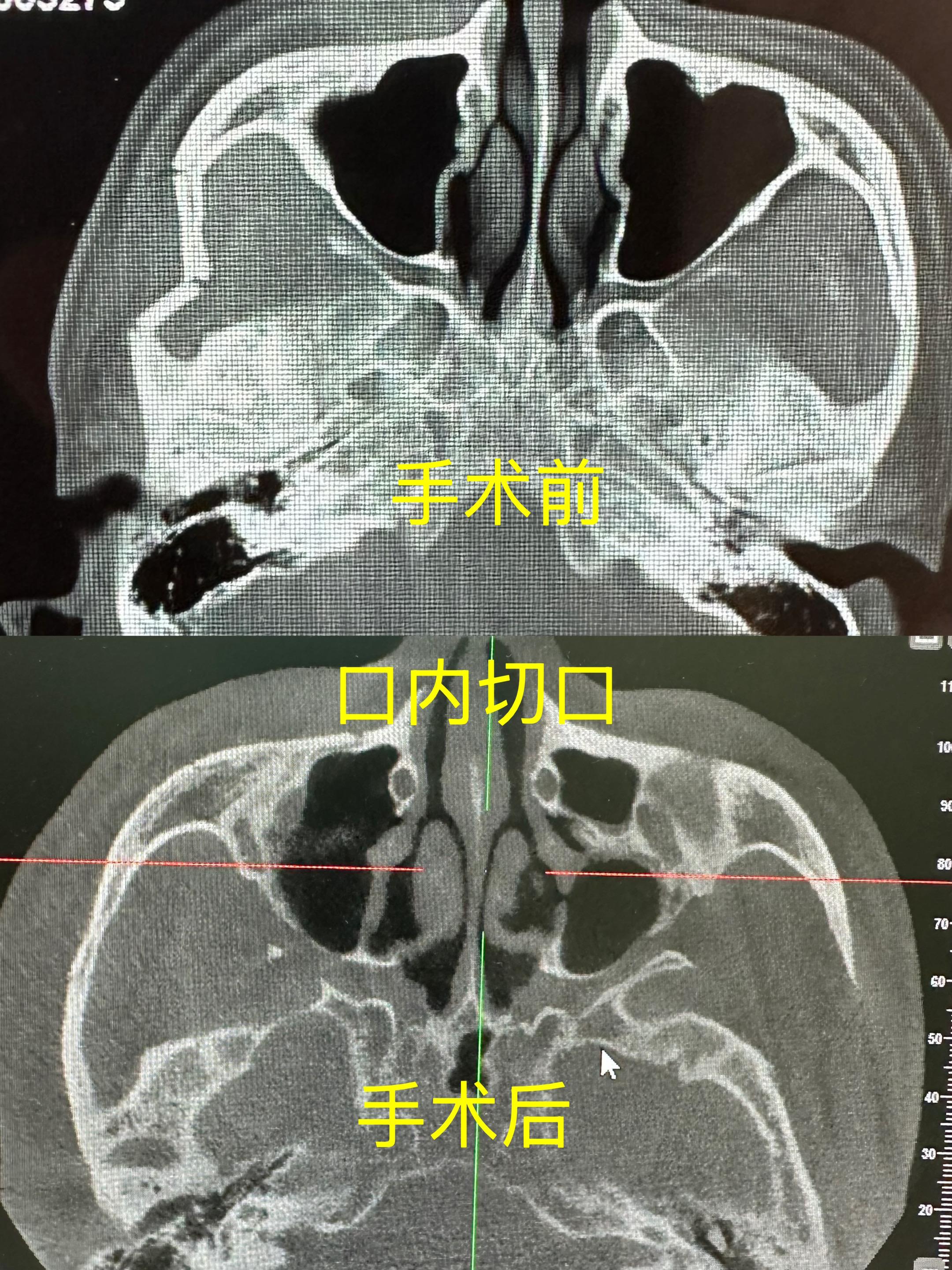 今日门诊小手术。10点钟在手术台上接同事电话，一个颧弓骨折在科里等我...