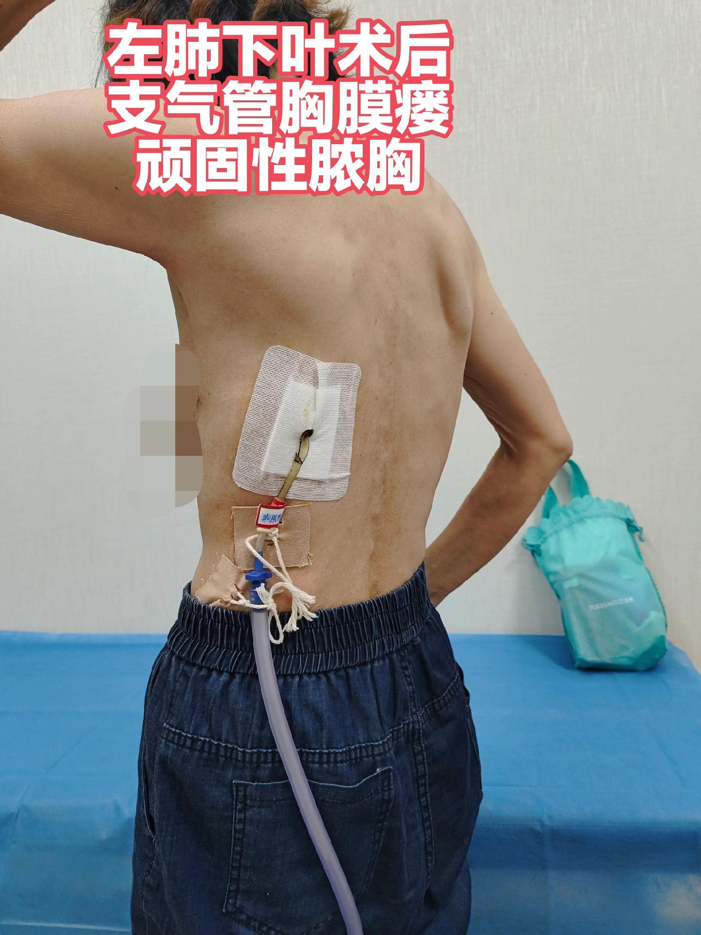 杭州病友，左肺下叶基底段切除术后，支气管胸膜瘘。七院微创修复术，一月复...