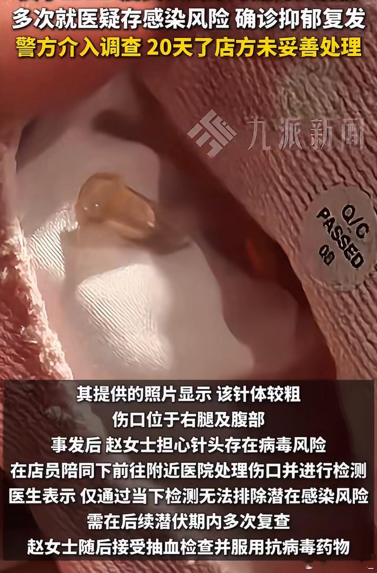 每日热议ZARA试穿被针扎女子称抑郁症复发有人故意在试穿的裤子里放了针头？？？？