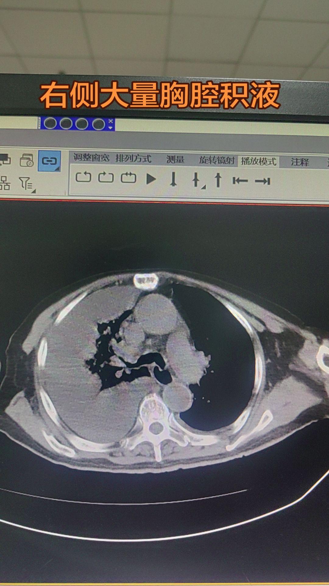 记录医生工作的日常 肺部影像检查