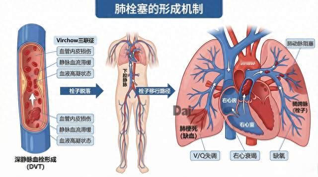 一天坐车最多12小时，26岁女子吃避孕药后查出肺栓塞