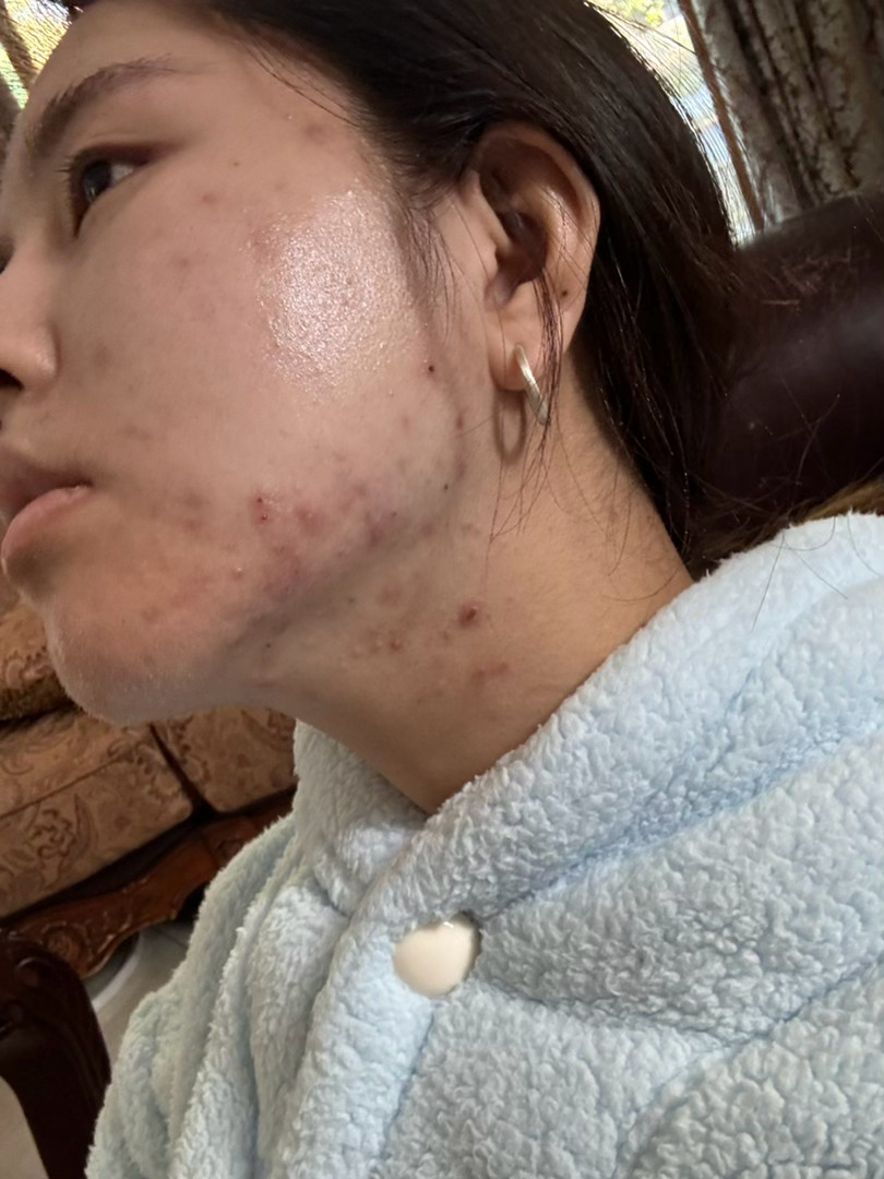 我的天我以前痤疮烂脸好恐怖……还很黑 