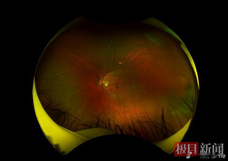 朱女士术前检查意外发现视网膜脱离，因高度近视且早期无症状险些失明。医生指出，视网