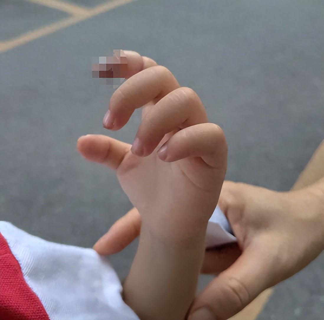 广东云浮一名刚满 2 岁的女童，在幼儿园午睡时自己把绑头发的橡皮筋缠在了左手食指