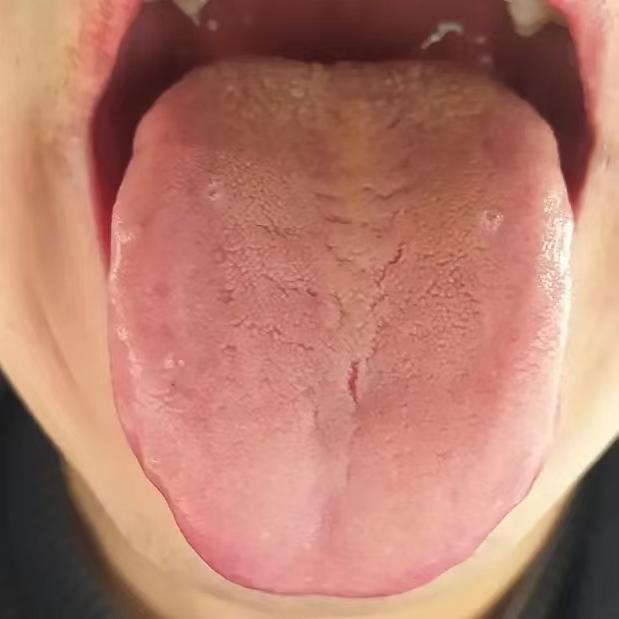 中下二焦又湿又热，龙胆泻肝不管用，就算是二妙也不行！
我前两天收到了这位粉丝的舌