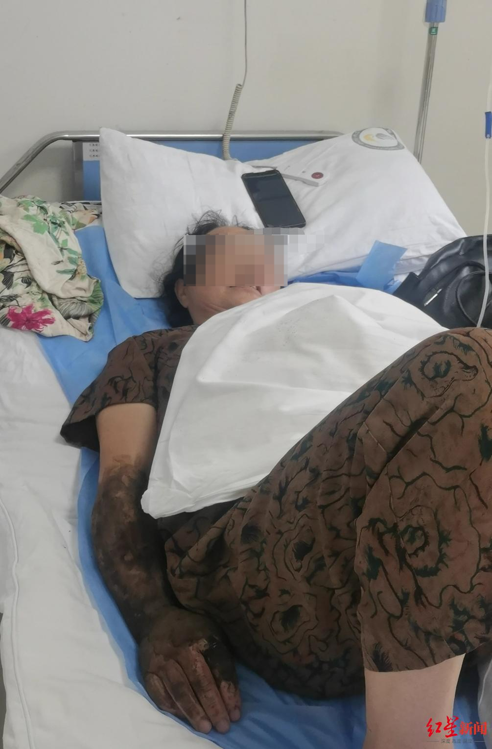 【#61岁阿姨家中用锤子打蛇被咬伤#】#女子打蛇被咬后拍照及时就医已消肿#61岁