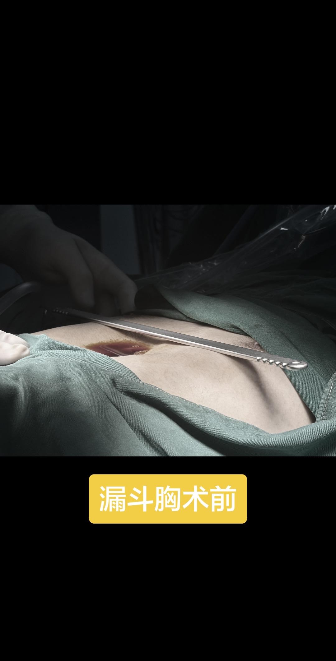 漏斗胸术前术后对比……