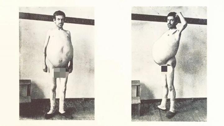 “他是被屎憋死的”1940年，美国人约翰因为便秘，三年没上厕所，最终暴毙，医生在