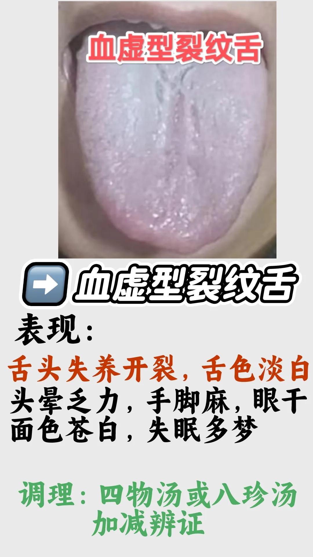 年前最后几次公益舌诊，且发且珍惜
注意：舌象拍全，包括舌根
拍照前不要吃染色食物