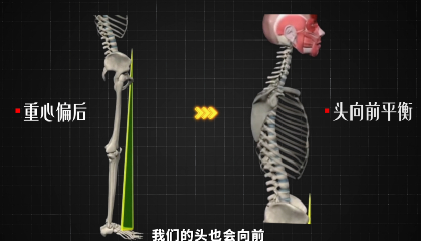 富贵包  颈后大包/富贵包，应该怎么纠正改善？今天就来和大家讲清楚——⚠️【富贵