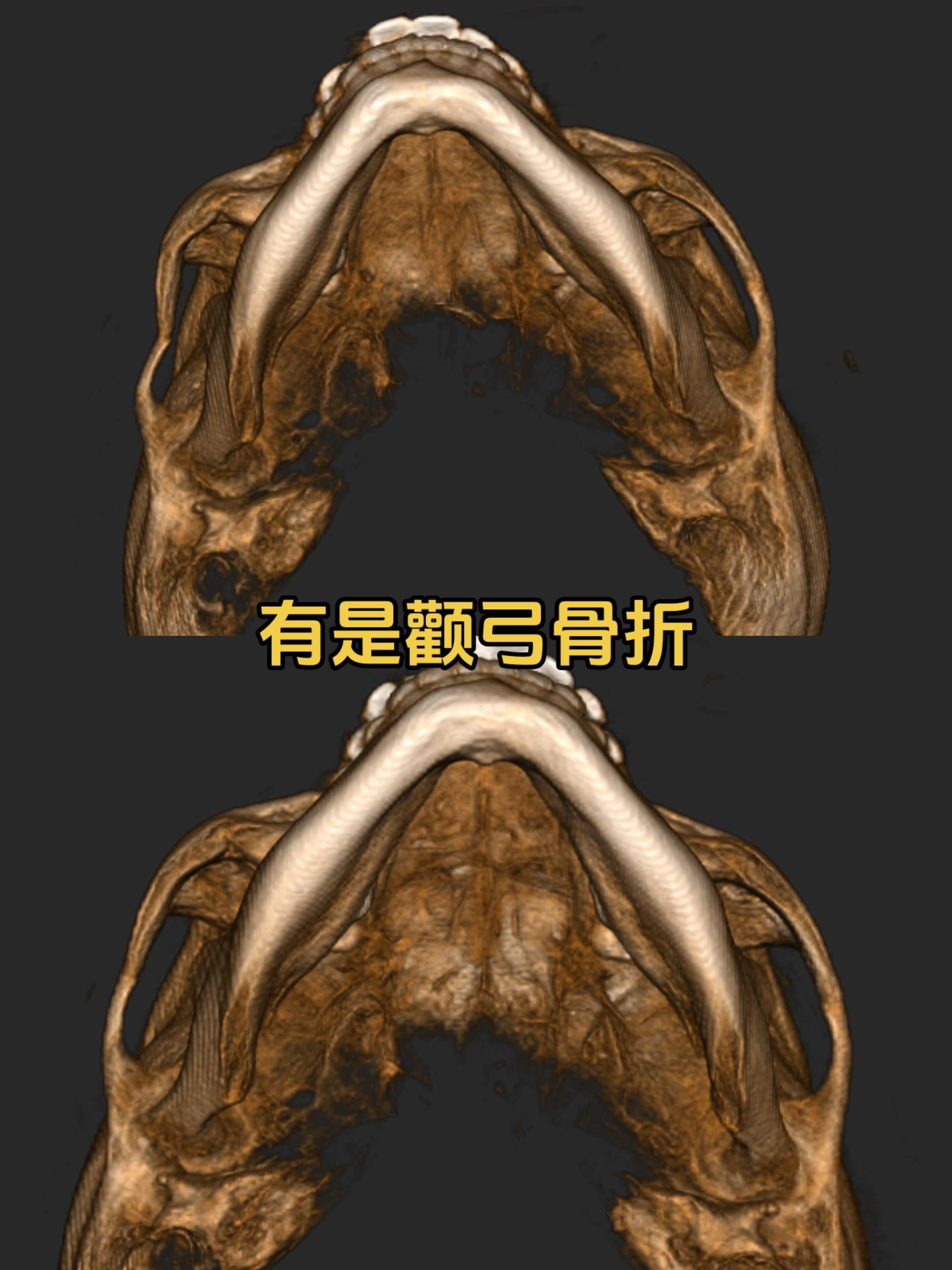 又是颧弓骨折。14岁的小姑娘 麻醉后两三分钟搞定。