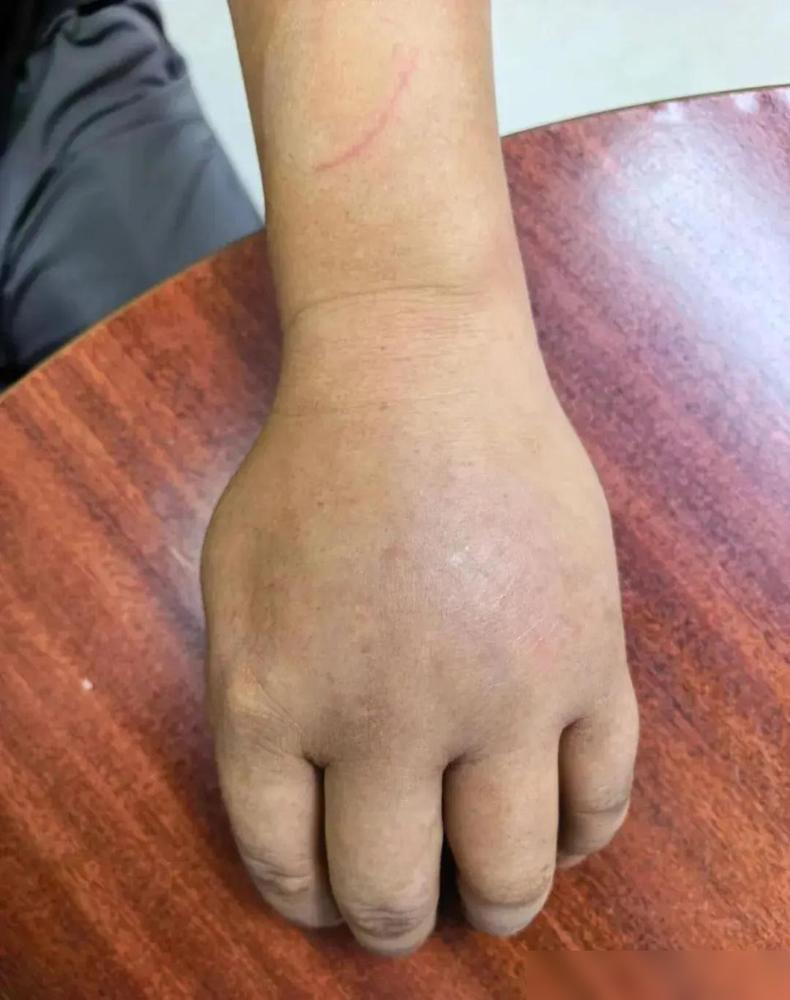 “蛇见了我都绕道走！”浙江男子上山采蘑菇，无视老婆提醒，刚要摘就被一条竹叶青咬了