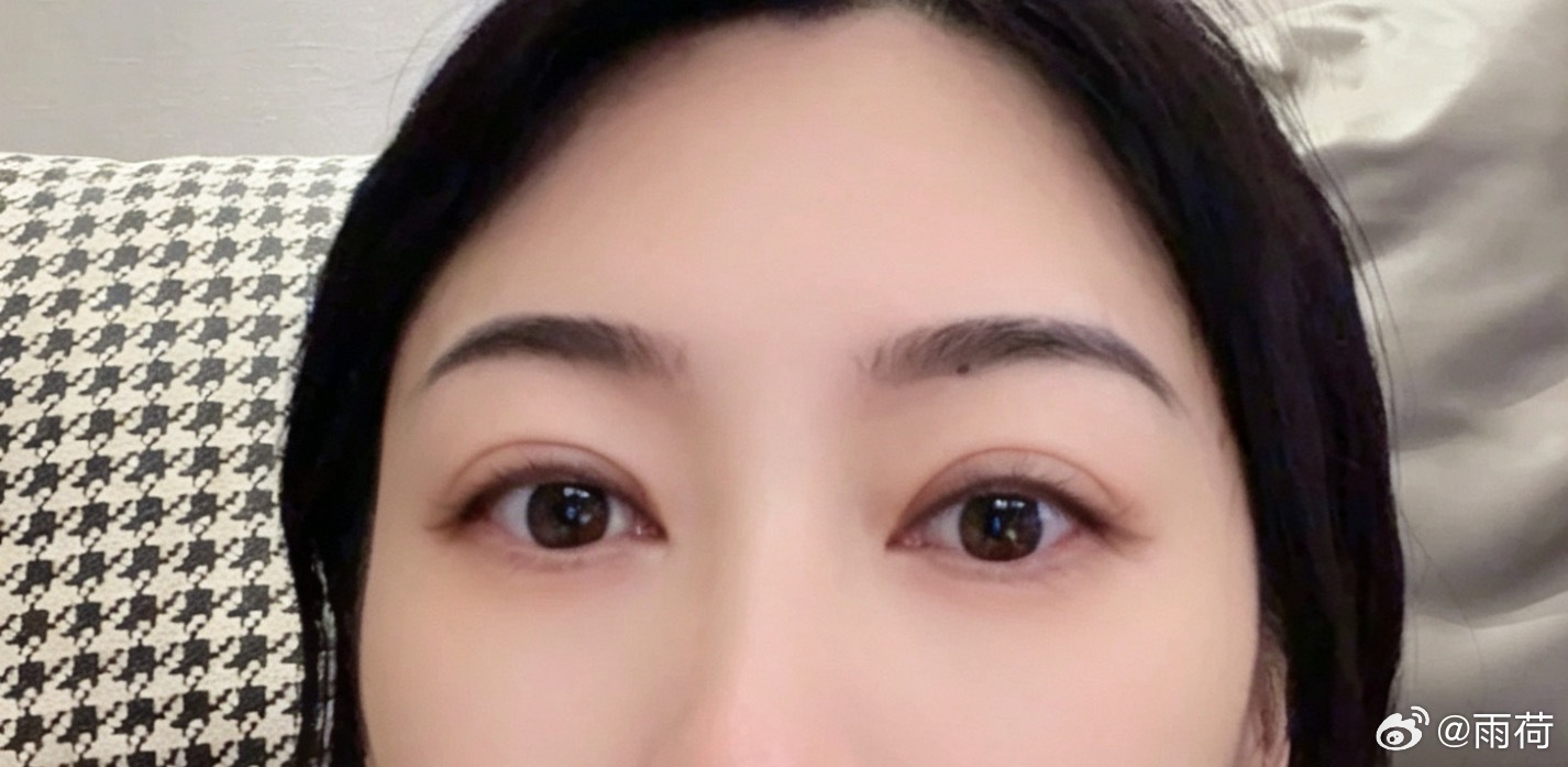 修复完双眼皮，医生说不用涂疤痕膏，所以这一个月都在严格忌嘴。牛羊肉，海鲜，辛辣，