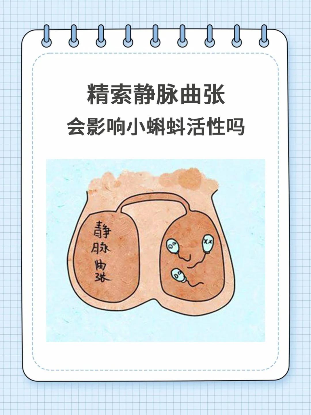 【精索静脉曲张 你的