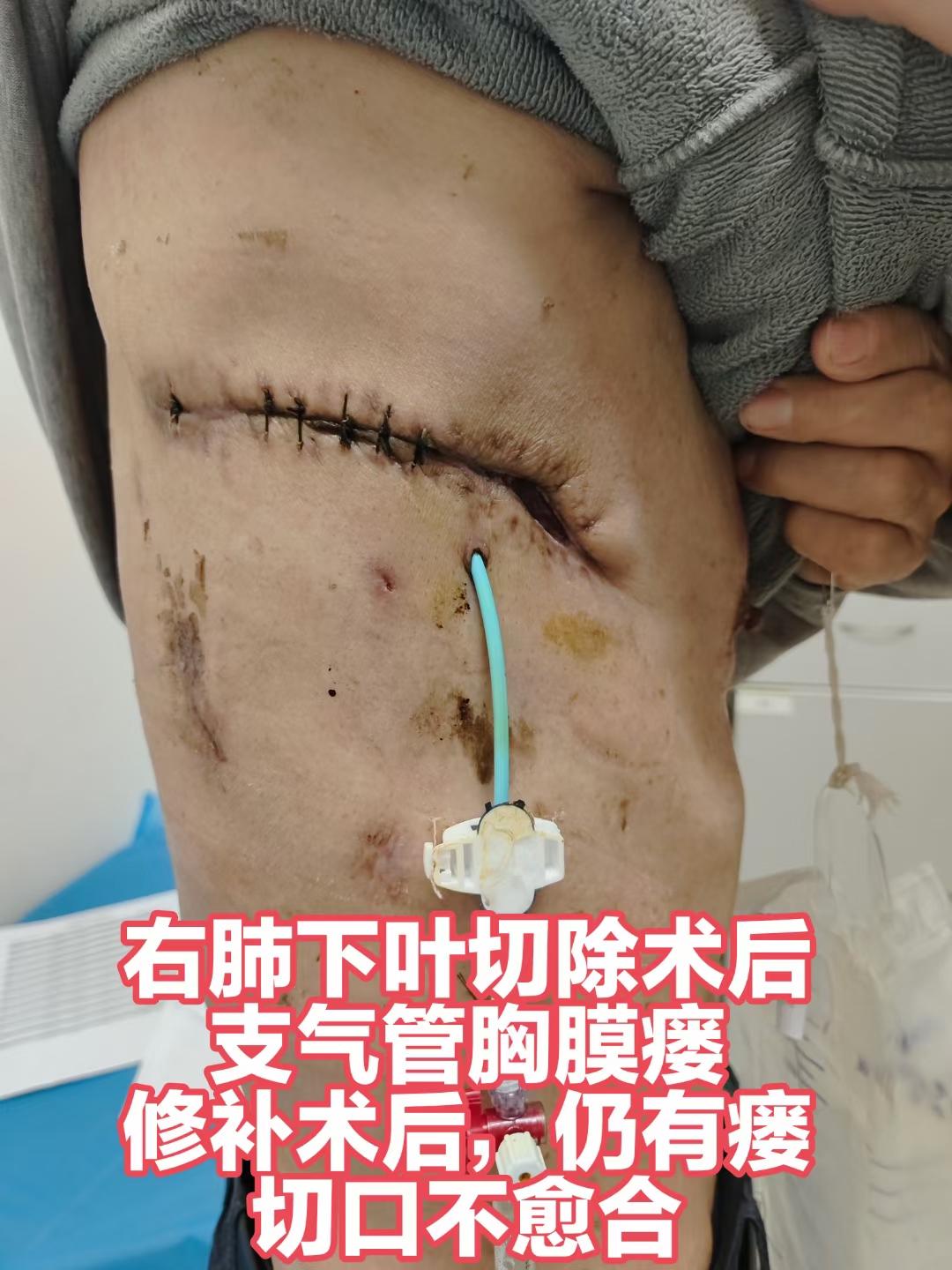 右肺下叶切除术后支气管胸膜瘘，修补术后仍有瘘。家属连夜赶来七院咨询，又...