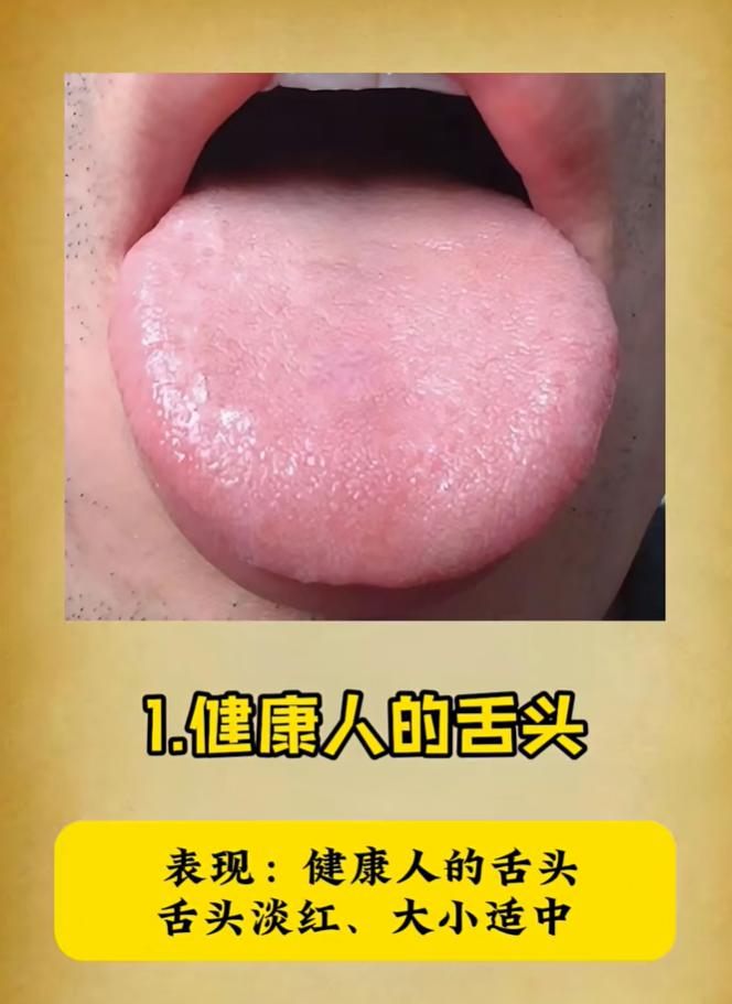 五种肾脏问题舌象对照，看舌头分清肾虚类型