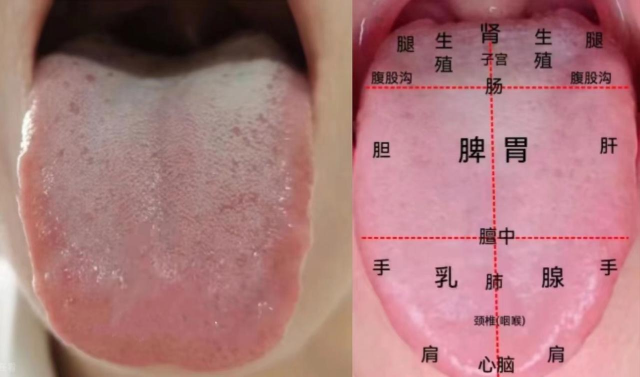 肝郁+脾虚，最难治的慢性病！
这是个35岁的女病人，来找我之前喝了三个月的祛湿茶