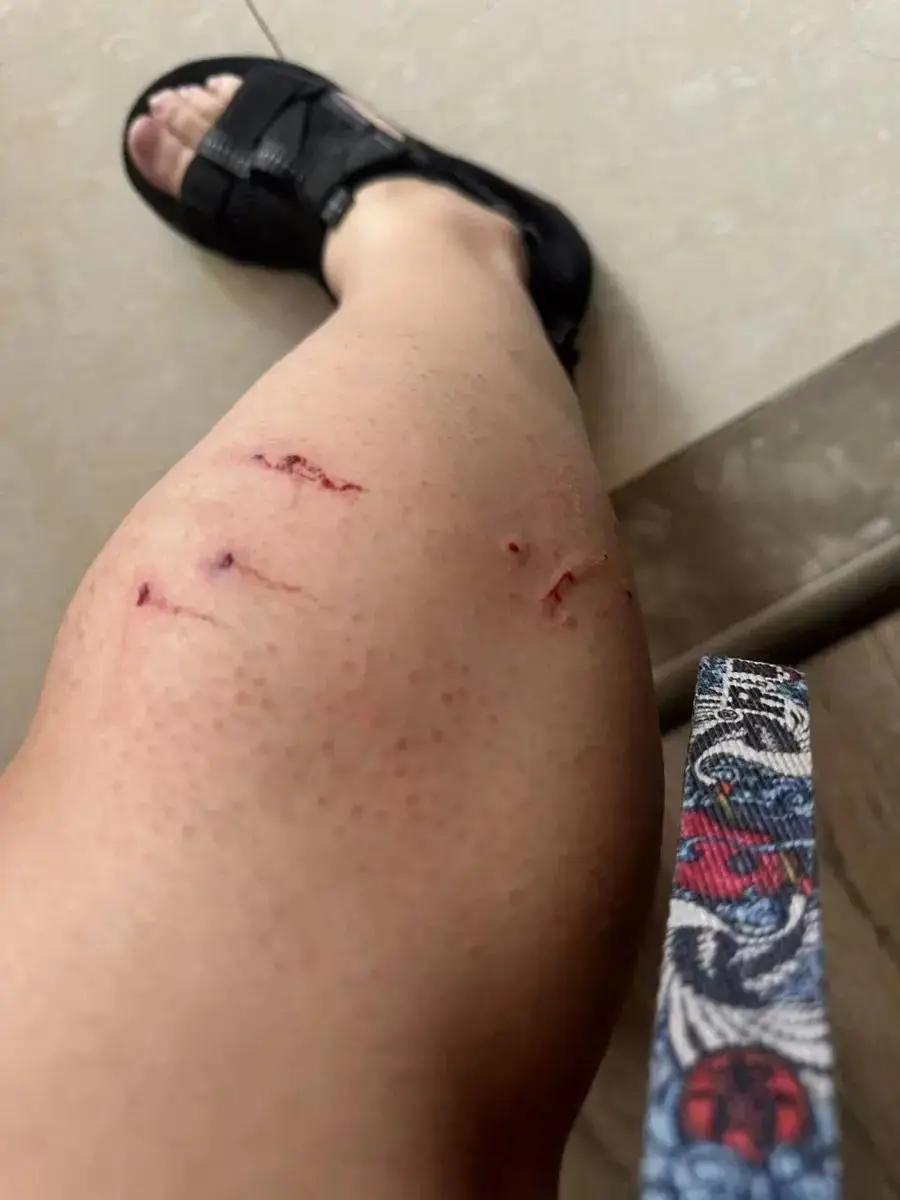 云南澜沧，一女子被邻居家小狗咬伤膝盖和脚，邻居赶紧带她去打了狂犬疫苗，可万万没想