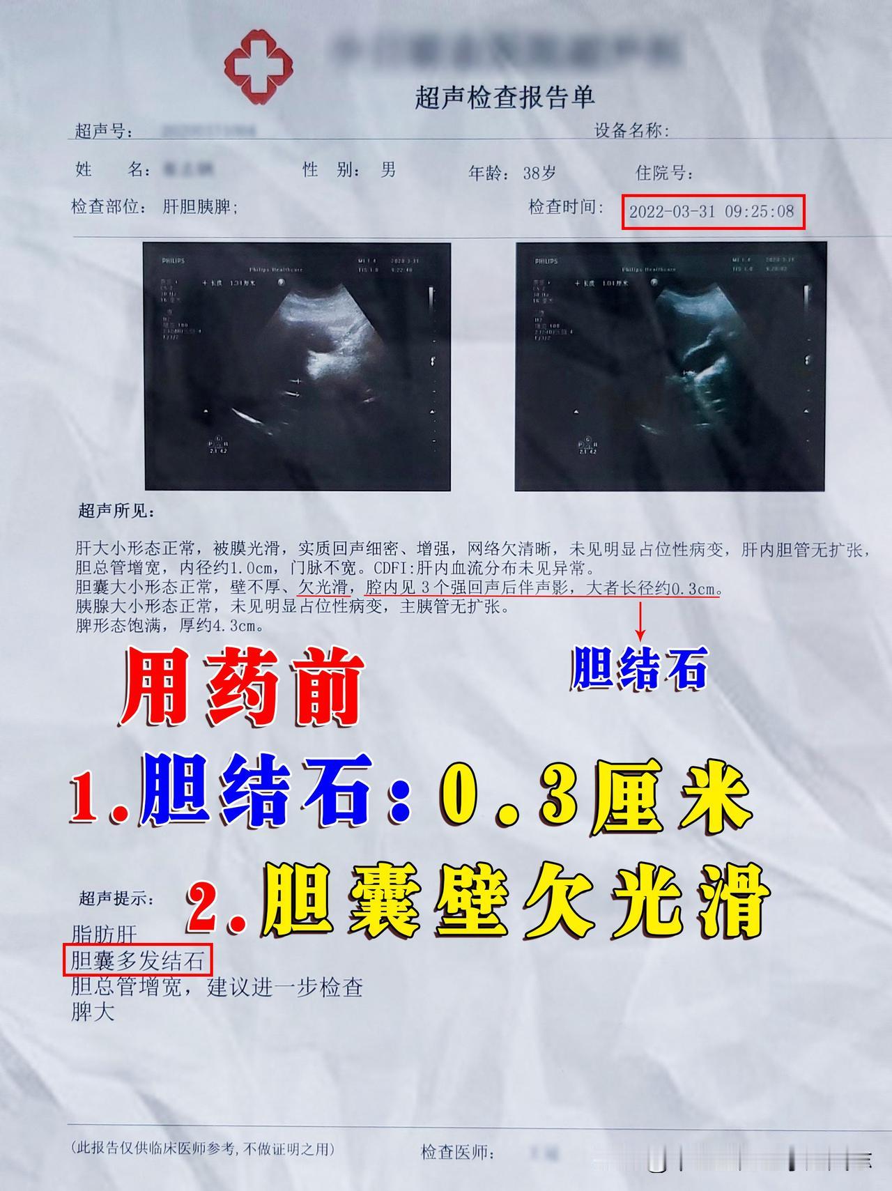 这个患者因为腹部隐隐作痛，以为胃有问题了，就用了一些药，用药之后呢效果不理想，就