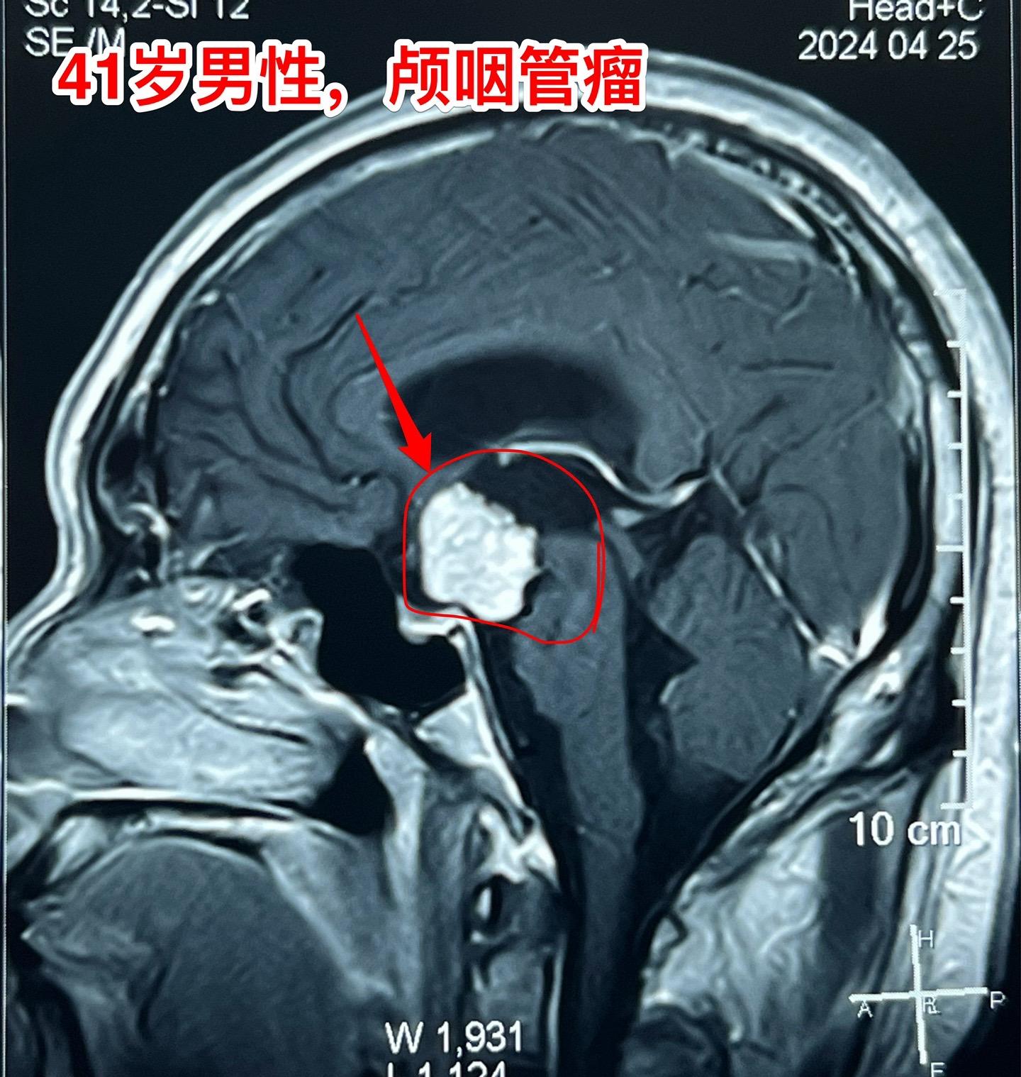 三个月颅咽管瘤直径增加了1厘米。41岁辽宁省沈阳的男性，五个月前因眼前发花到医院检查发现颅咽管瘤，同时期他的一个吉林省的朋友也发现患有颅咽管瘤（吉林省朋友的颅咽管瘤有钙化，2024.1.25在我科作了手术）（沈阳病人的颅咽管瘤没有钙化）。
       惧怕手术是人之常情。沈阳患者发现颅咽管瘤后也是害怕作手术的，所以他选择试试中药治疗，到成都某医院去看病，服用中药三个月，到2024年4月复查磁共振显示肿瘤的直径长大了1厘米，同时视力症状也越来越明显，化验激素也出现下降。所以患者就下决心来找我作手术。