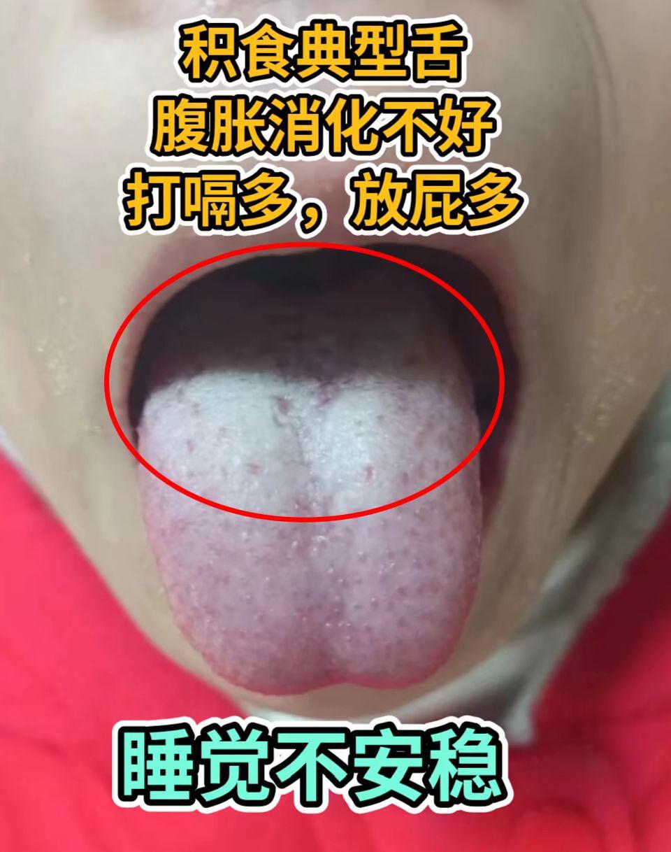 脾虚舌苔见过吗 看看你是哪种