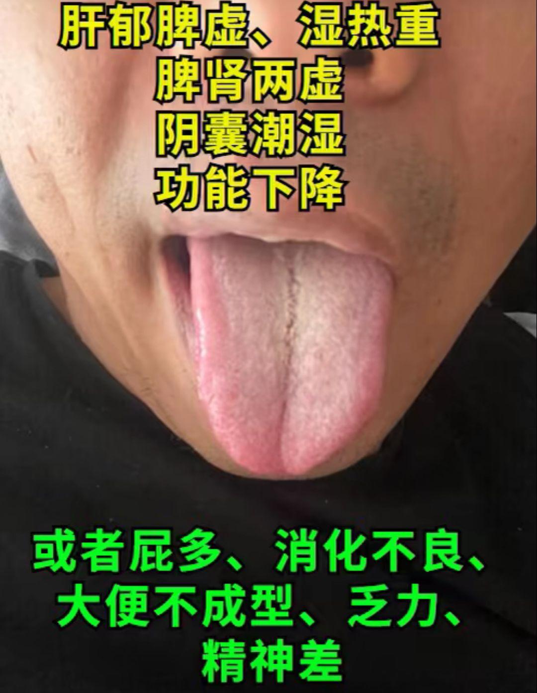 舌象分析 对照自己的舌象看看你是哪种