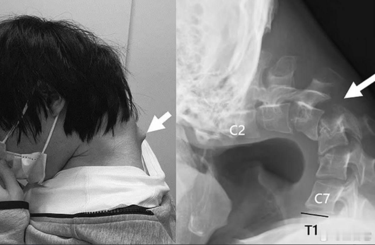 😱日本年轻男子多年沉迷手机，险些因“垂头综合症”死亡     一名 25 岁的