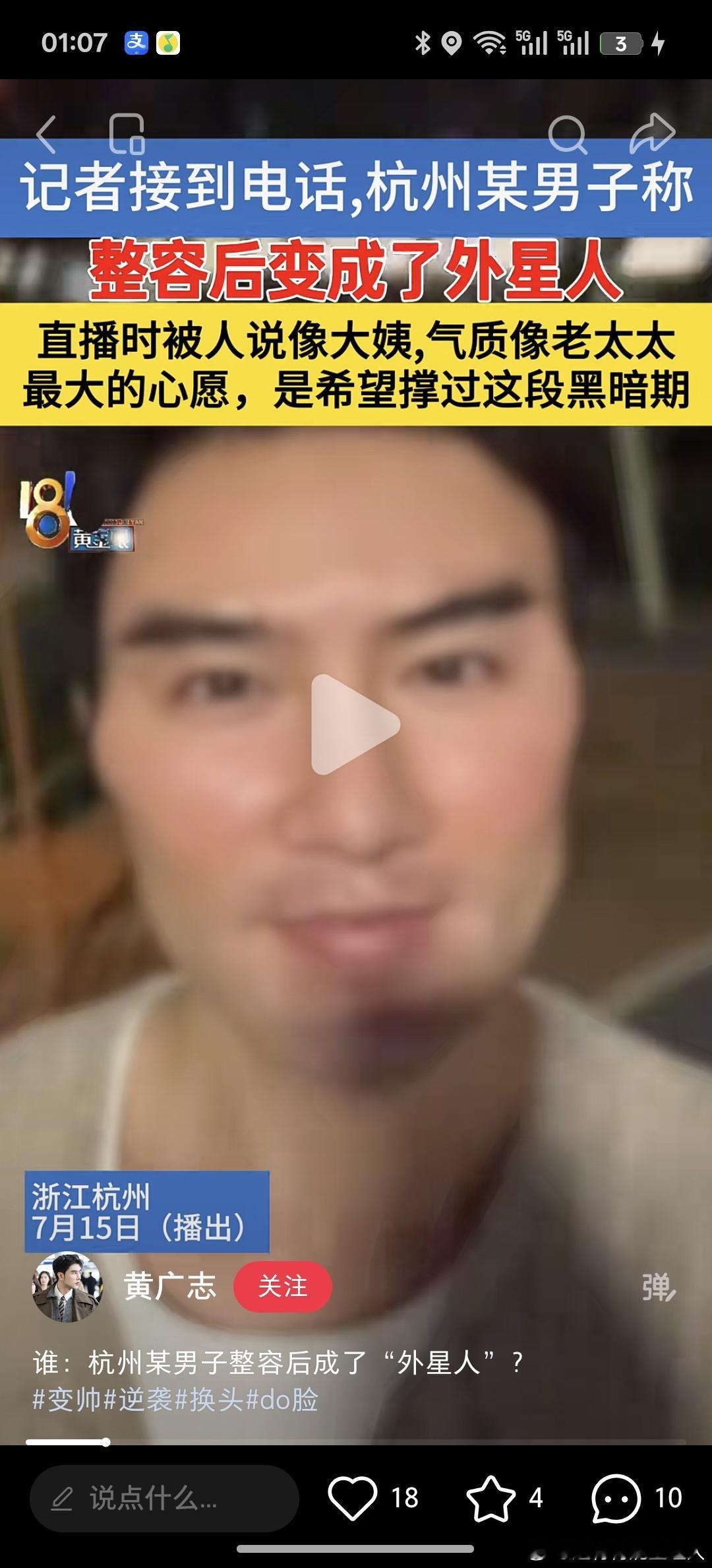 他do脸好像是把流行的都做了一遍颧骨 下颌角  下巴 眉弓都填过头了 