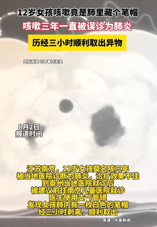 江苏，一女子伏案工作时咬笔帽，一个喷嚏呛入气管，咳嗽三年才被查出，肺里那枚白色塑
