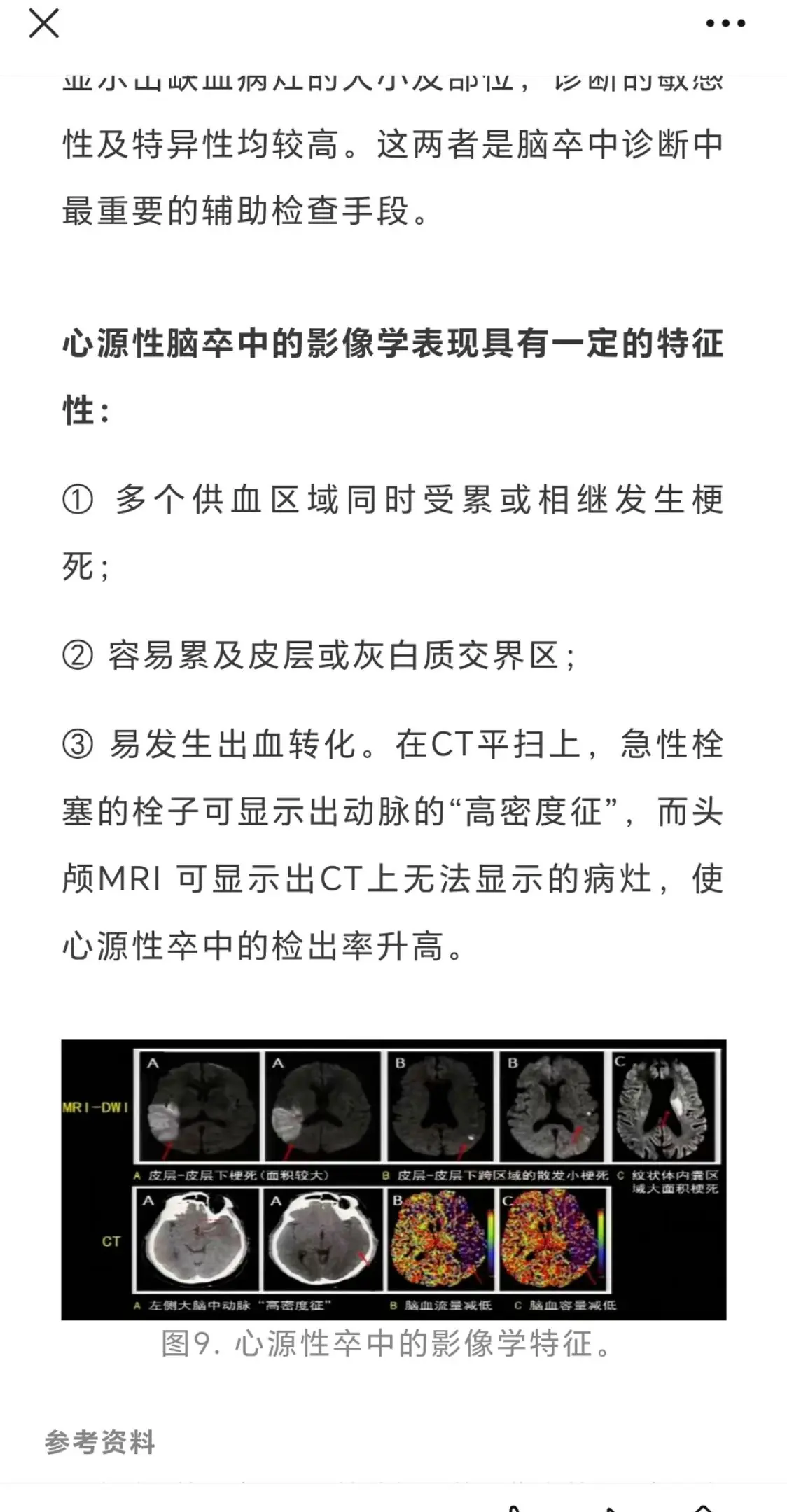 心源性脑栓塞。