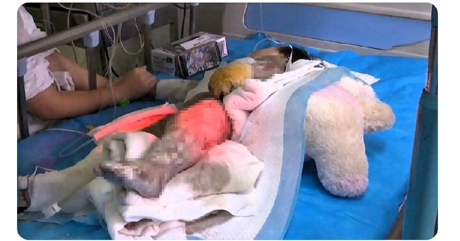 一名两岁女童因父母忙于家务不慎跌入开水锅，导致全身70%特重度烧伤，救治之路充满
