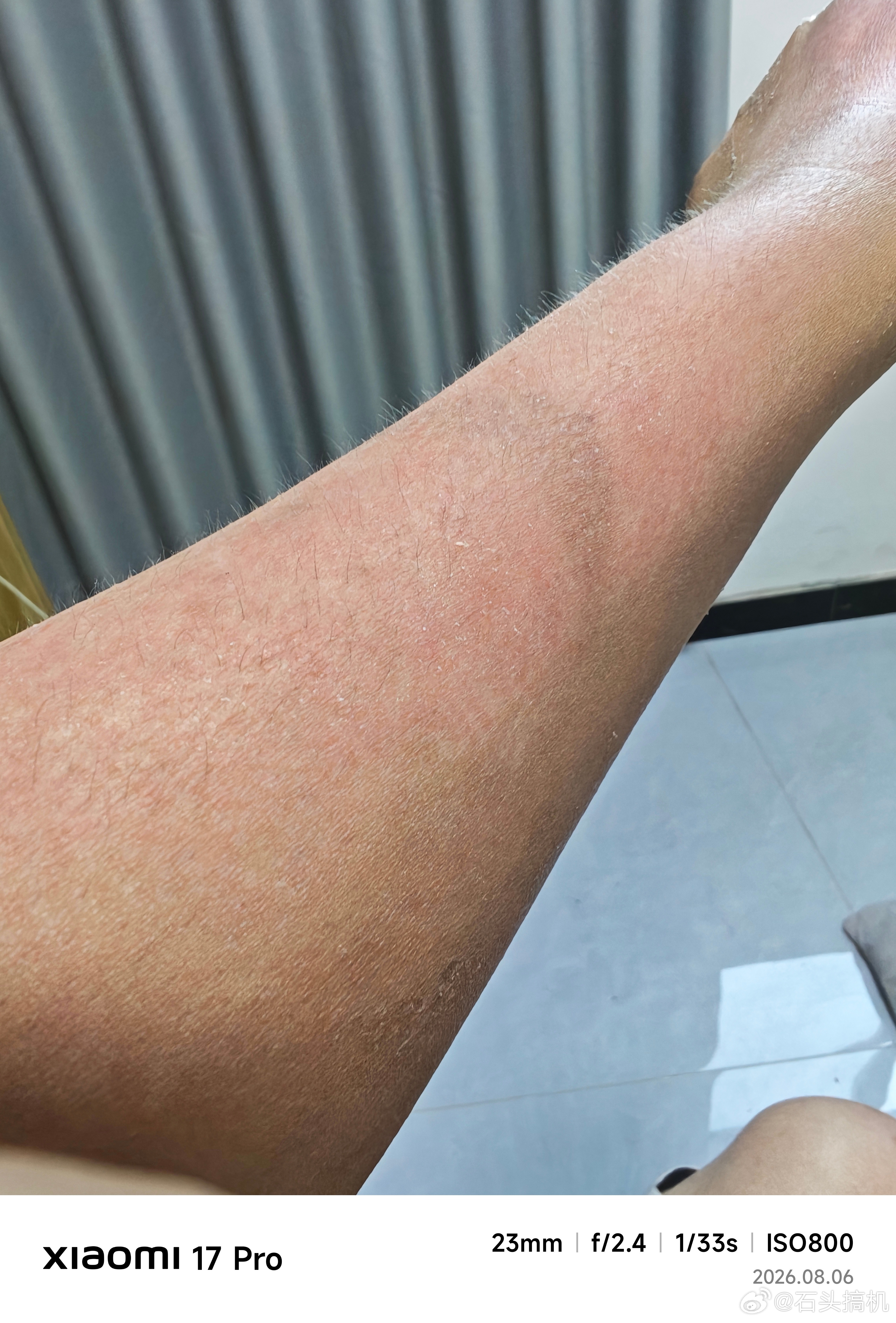 救火导致胳膊烫伤了，掉了一层皮，现在汗毛全都长出来了，整体恢复的还不错…所以，受