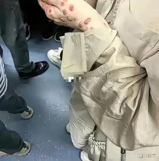 今天坐地铁被旁边女生的手吓一跳！那手上的也不知道啥疙瘩看着挺吓人，不过我在旁边看