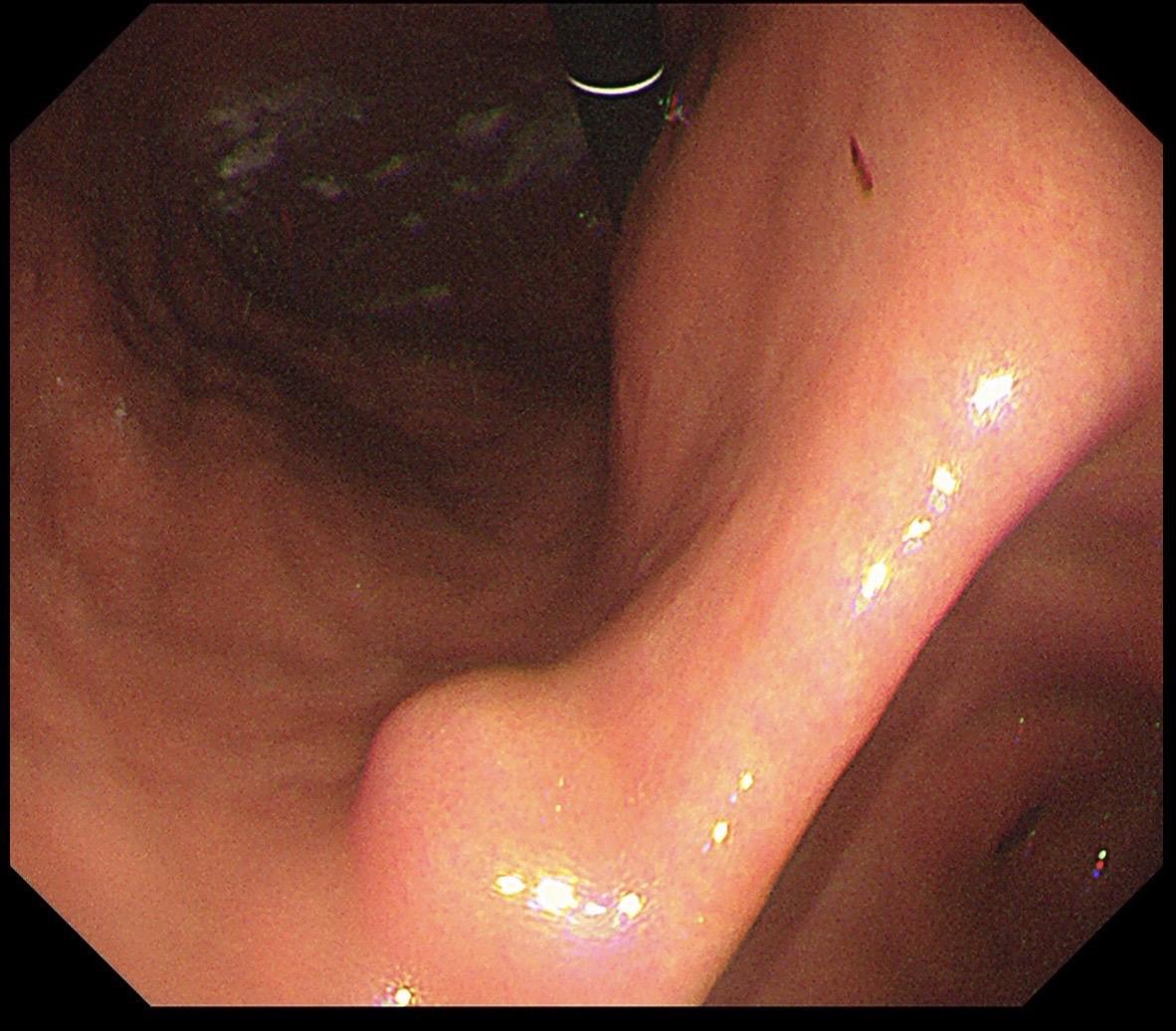 【精于术，简于形】 一例胃角间质瘤内镜下全层切除。 肿瘤虽小（2cm）...