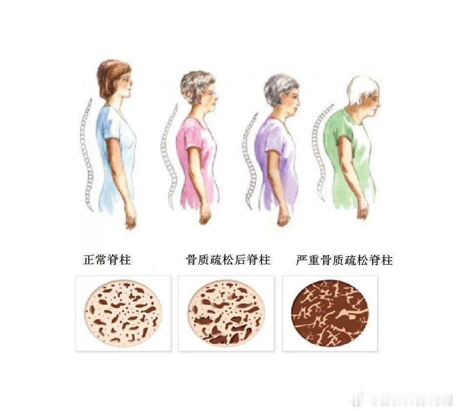 #健康食验计划##这个问题吃什么# 【如何预防骨质疏松？】1、增加饮食中钙及适量