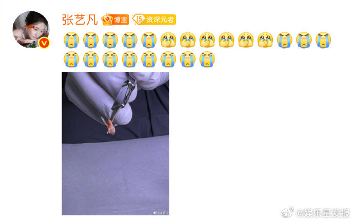 张艺凡自曝患甲沟炎 张艺凡空降超话聊起自己患甲沟炎的经历，隔着屏幕都能感受好疼！