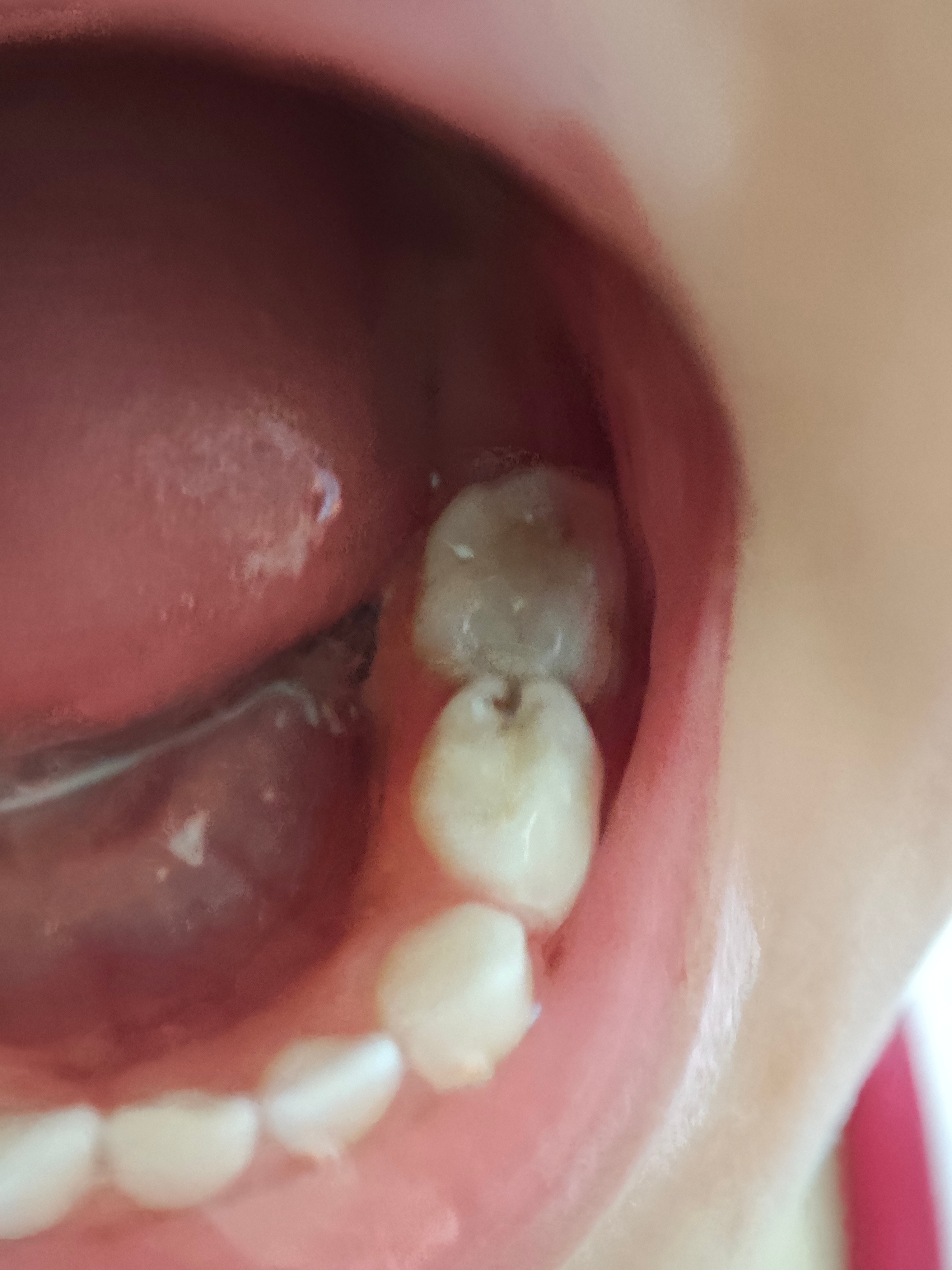 武汉 补的就是这一颗蛀牙，全程十分配合。 