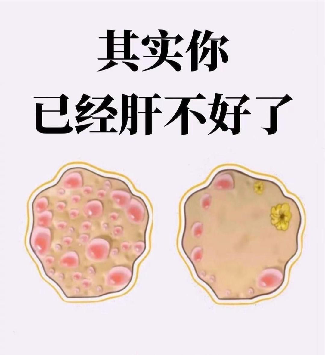 其实，你已经肝不好了，码住！