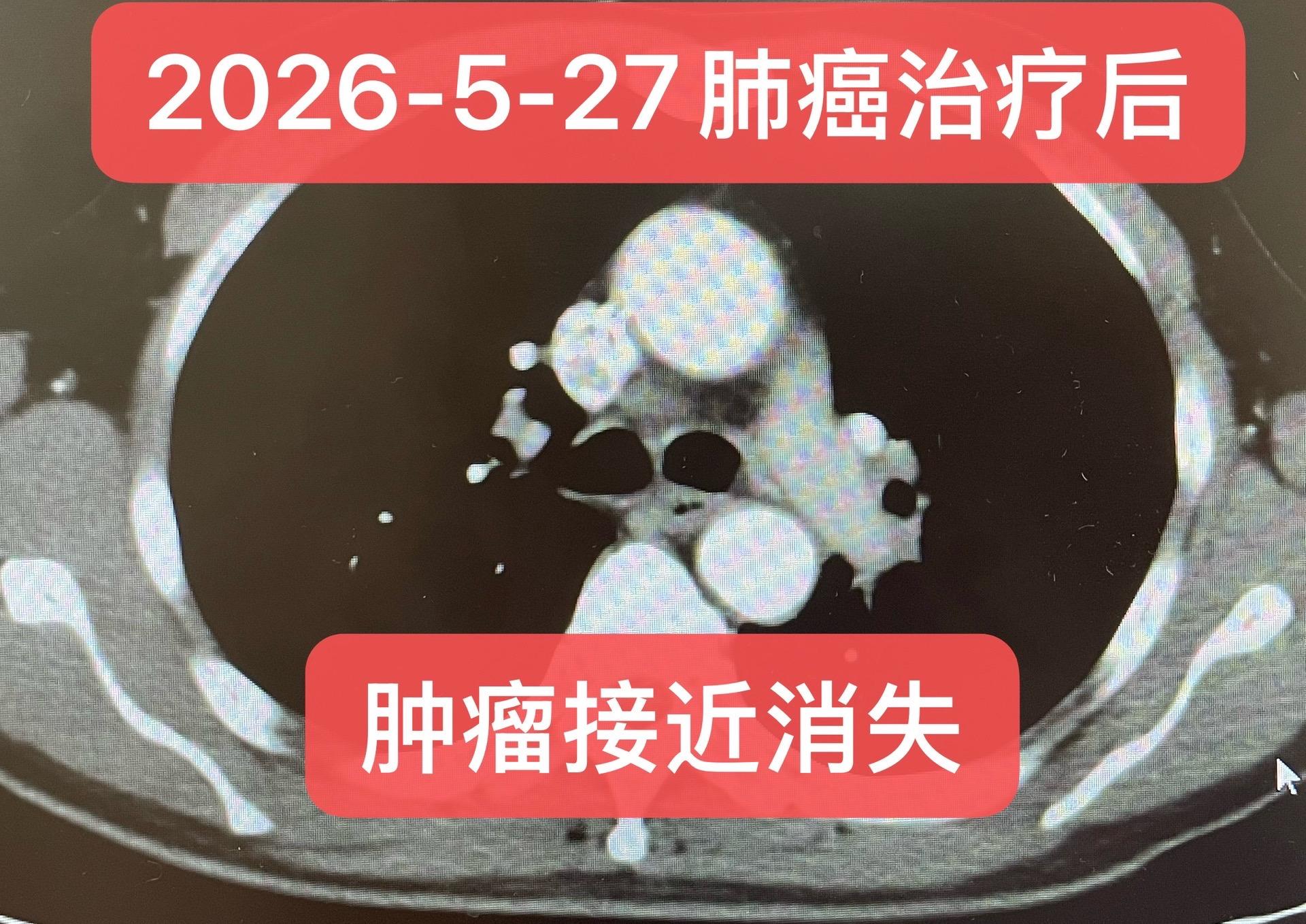 局部晚期-肺鳞癌的转化治疗方案。患者，男，57岁。诊断为左肺鳞癌（T4...