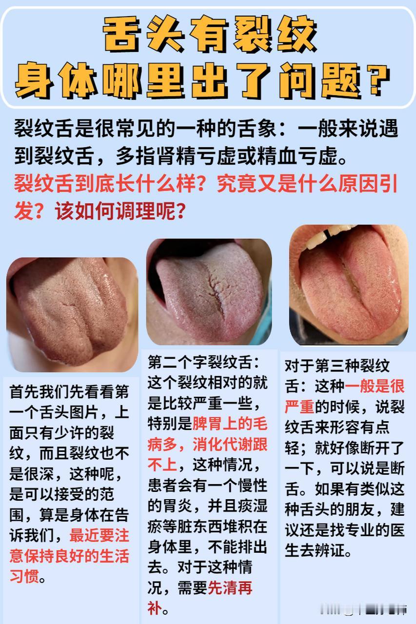舌头有裂纹是什么哪里出了问题，你知道吗？#健康##舌象#