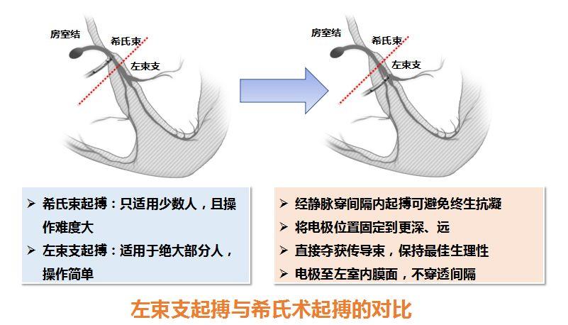 给大家看看最近学习的一些文献，这些文献是关于心脏起搏器中左束支起搏的。左束支起搏