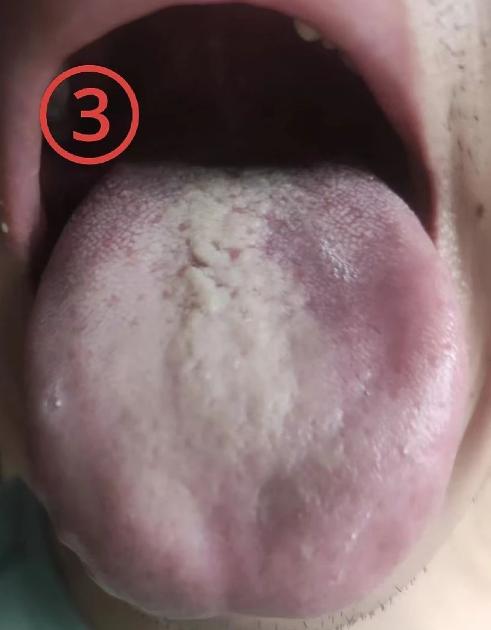 脾胃寒虚怎么看？这个舌象非常好！！
今天出场的病友，舌苔分布不均，舌中间特别厚，