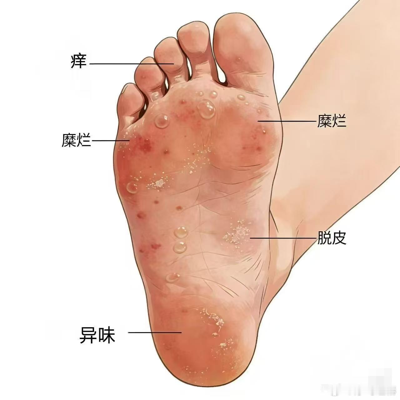 衡阳博士立志解决三亿人的困扰 每当看到脚气反复发作，我心里总是无奈，感谢彭艳博士