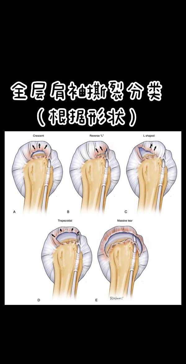全层肩袖撕裂分类（根据形状）