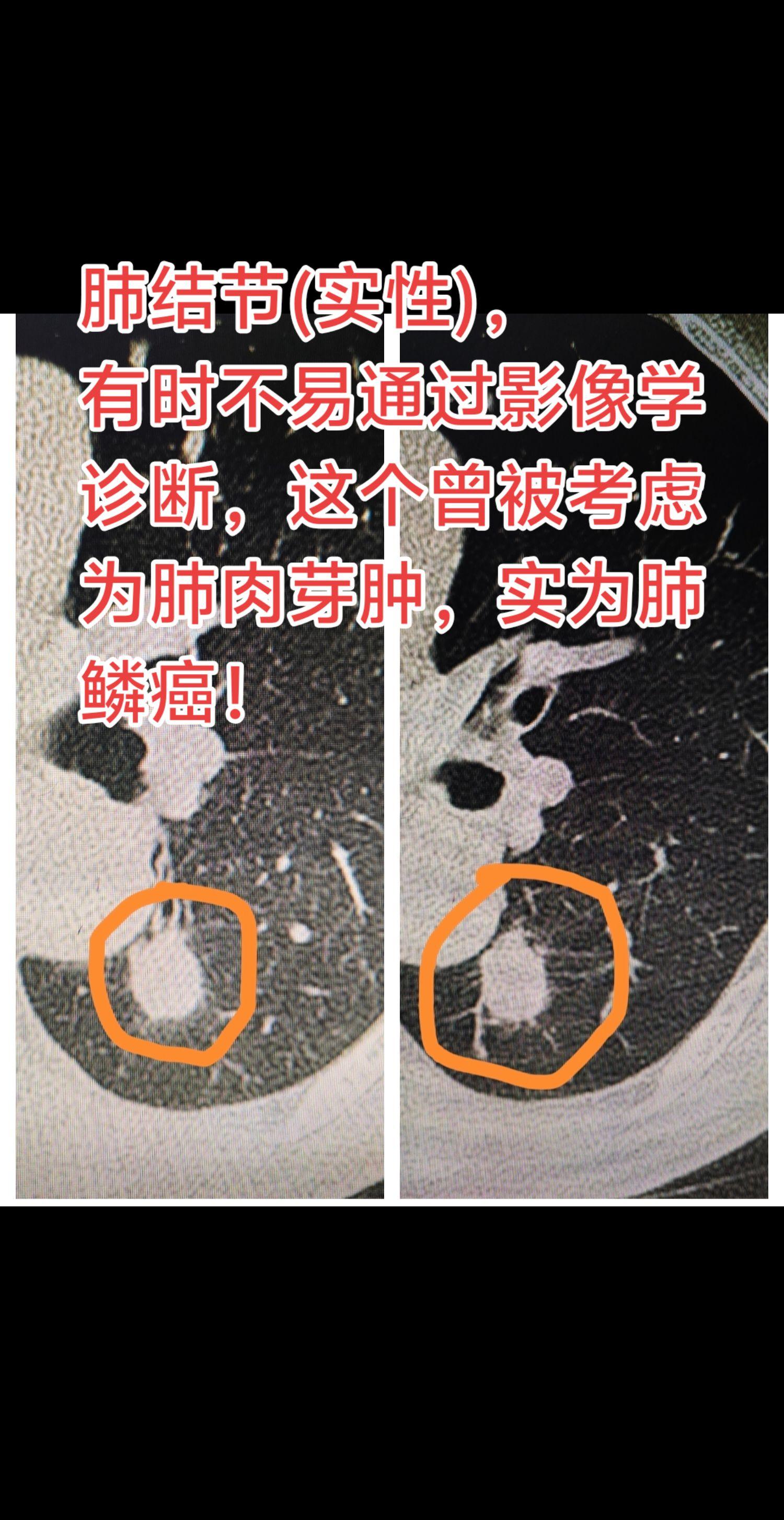 肺结节的准确诊断。肺结节(实性)，有时不易通过影像学诊断，这个曾被考虑...
