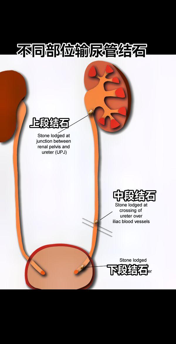 不同部位输尿管结石
