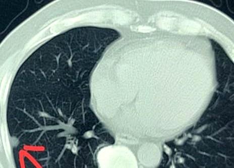 68岁男性患者，因为感冒后咳嗽一直没好，就来医院做了个胸部CT。

结果偶然发现