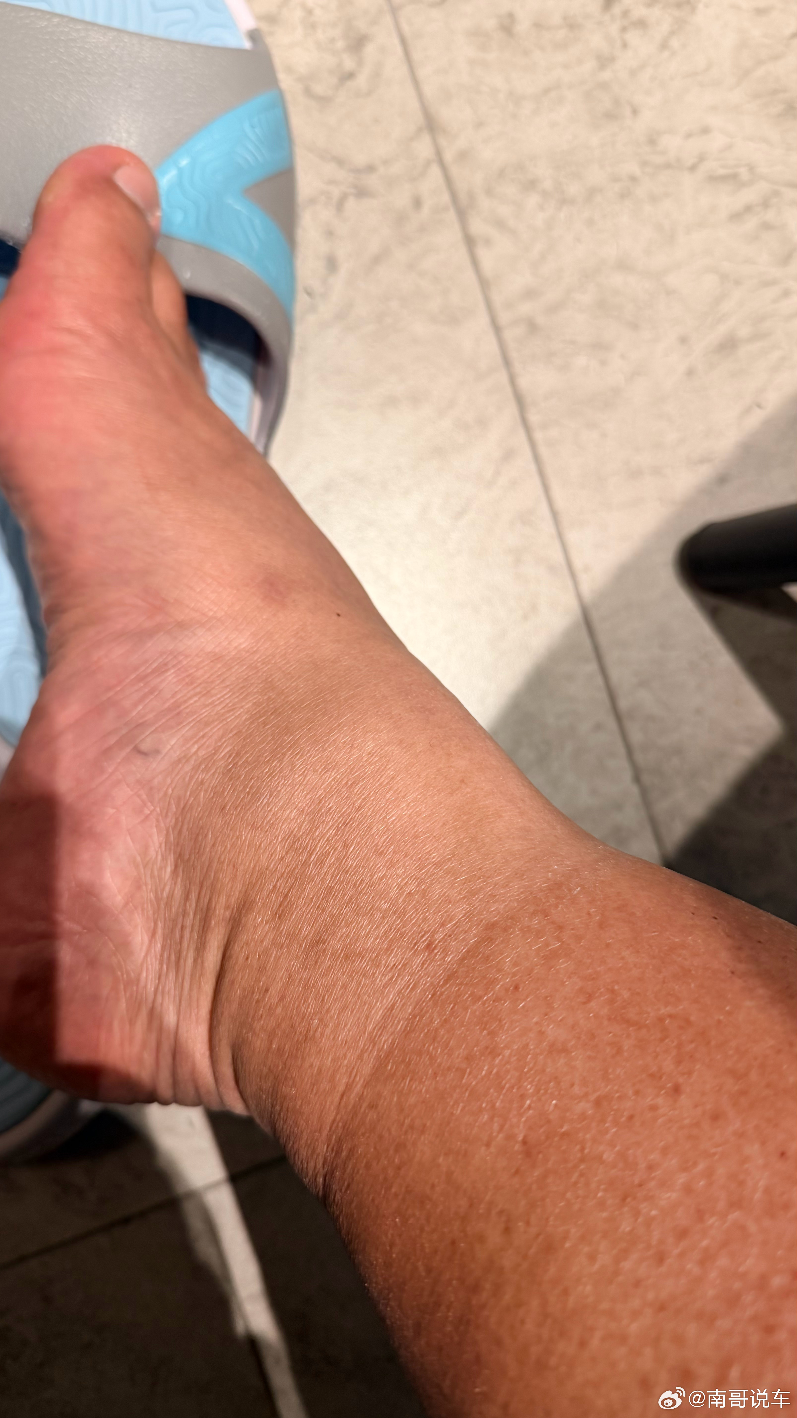 完犊子  脚肿成馒头了 